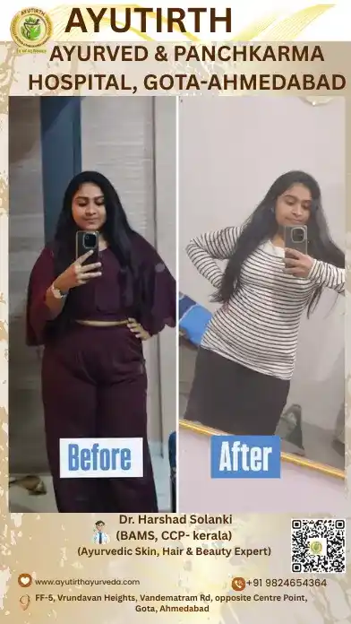 Virechan Treatment Results