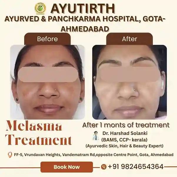 Melasma Skin Treatment Result